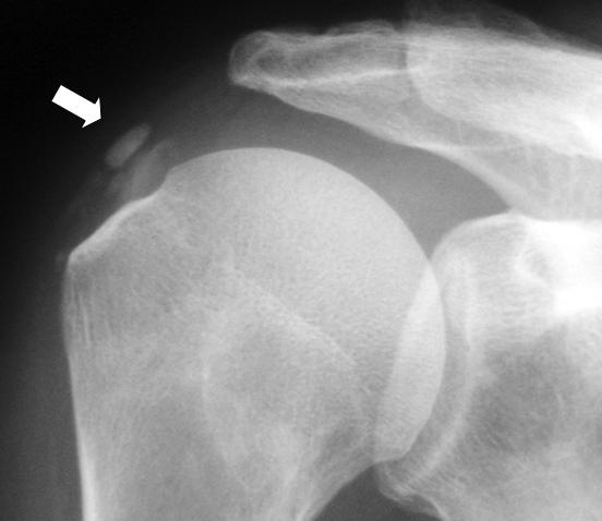 Calcificacion de T. Supraespinoso