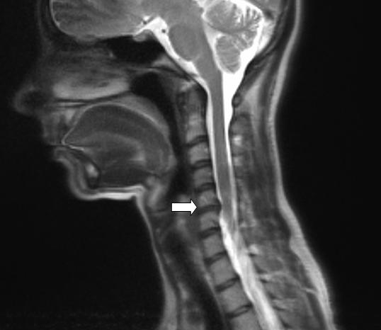 Hernia cervical c5-c6