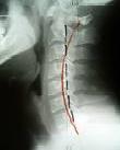 Rectificación cervical